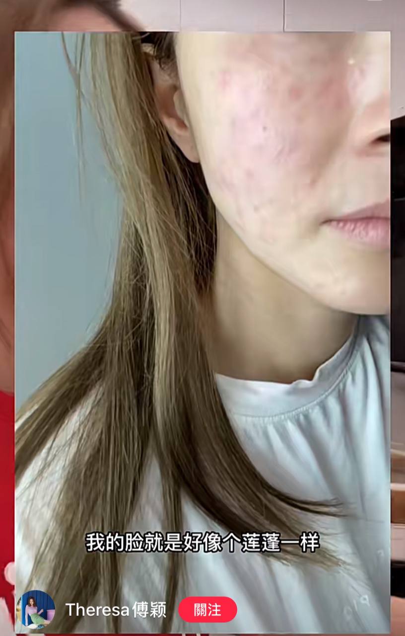 傅穎表示自己吃蓮子過敏，導致皮膚敏感。